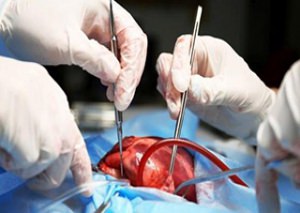 جراحی قلب و عروقمعرفی محصولات 