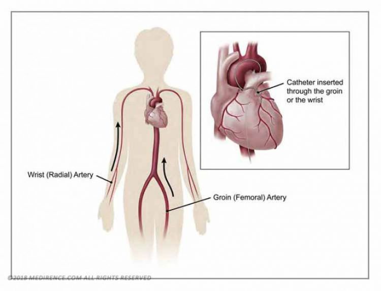 cardiac-catheterization